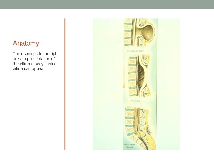 Anatomy The drawings to the right are a representation of the different ways spina