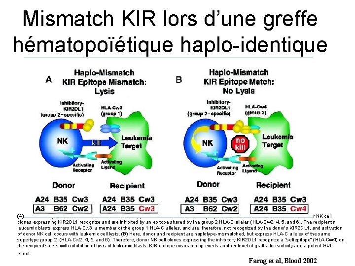 Mismatch KIR lors d’une greffe hématopoïétique haplo-identique (A) In this example, donor and recipient