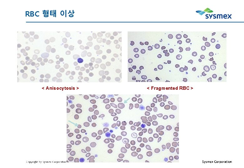 RBC 형태 이상 < Anisocytosis > < Fragmented RBC > 