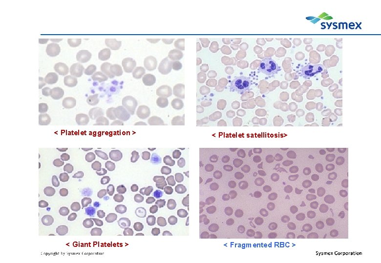 < Platelet aggregation > < Giant Platelets > < Platelet satellitosis> < Fragmented RBC