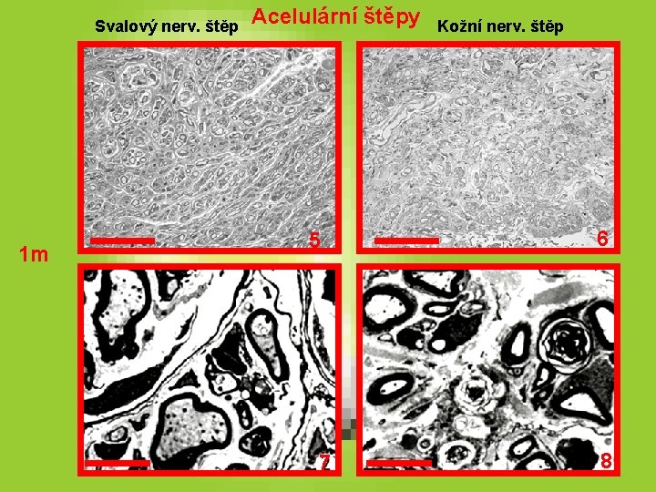 Svalový nerv. štěp 1 m Acelulární štěpy 5 7 Kožní nerv. štěp 6 8 Svalový nerv. štěp 1 m Acelulární štěpy 5 7 Kožní nerv. štěp 6 8