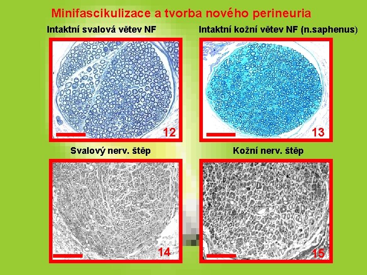 Minifascikulizace a tvorba nového perineuria Intaktní svalová větev NF Intaktní kožní větev NF (n. Minifascikulizace a tvorba nového perineuria Intaktní svalová větev NF Intaktní kožní větev NF (n.
