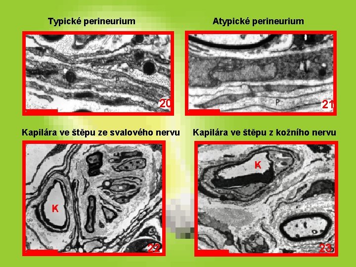 Typické perineurium Atypické perineurium 20 Kapilára ve štěpu ze svalového nervu 21 Kapilára ve Typické perineurium Atypické perineurium 20 Kapilára ve štěpu ze svalového nervu 21 Kapilára ve