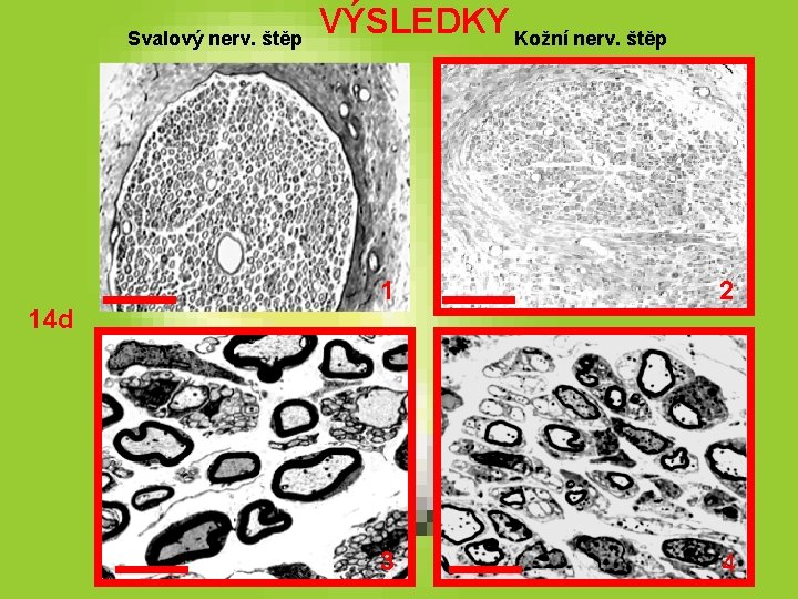 Svalový nerv. štěp 14 d VÝSLEDKY Kožní nerv. štěp 1 2 3 4 Svalový nerv. štěp 14 d VÝSLEDKY Kožní nerv. štěp 1 2 3 4