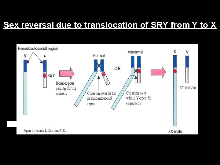 Sex reversal due to translocation of SRY from Y to X 