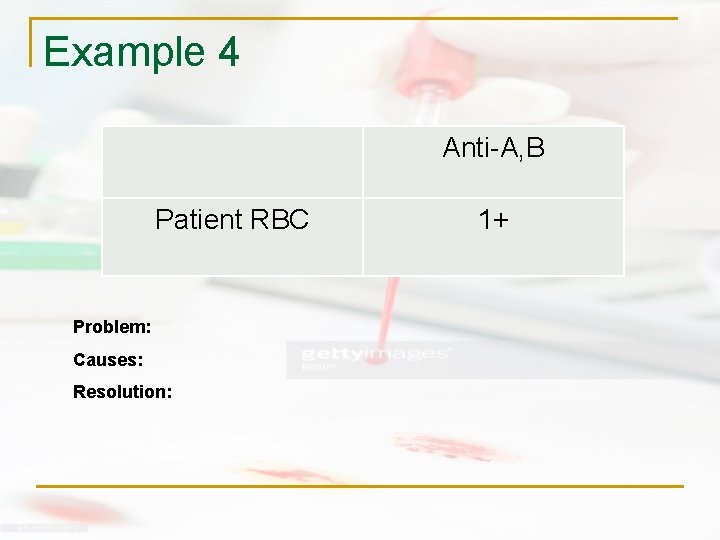 Example 4 Anti-A, B Patient RBC Problem: Causes: Resolution: 1+ 