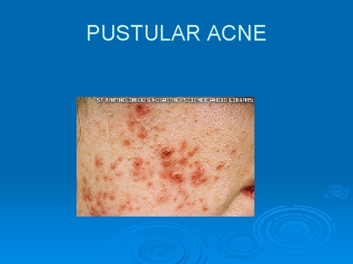 PUSTULAR ACNE 