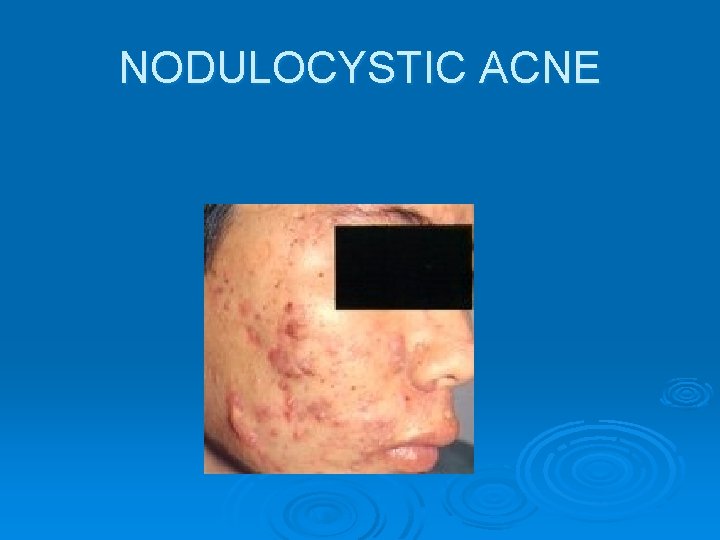 NODULOCYSTIC ACNE 