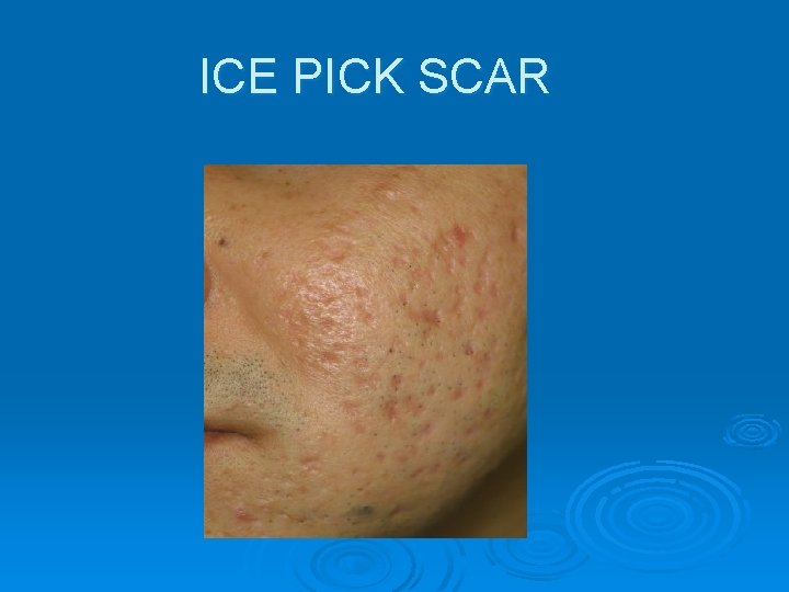 ICE PICK SCAR 