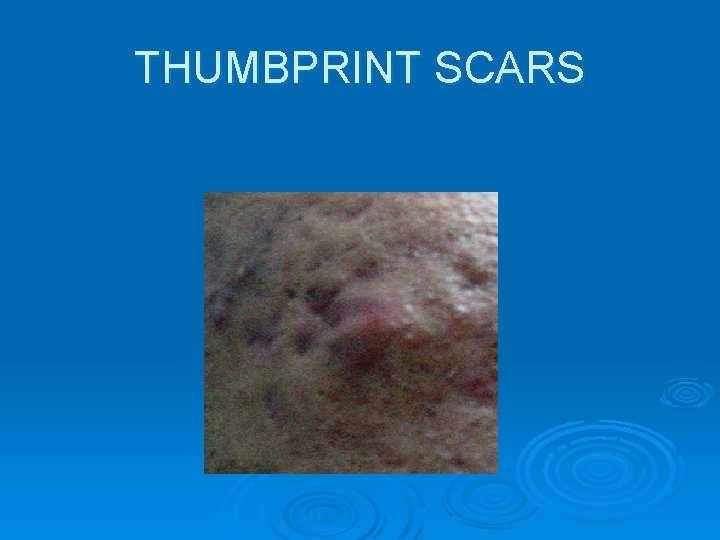 THUMBPRINT SCARS 