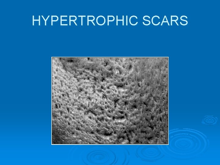 HYPERTROPHIC SCARS 