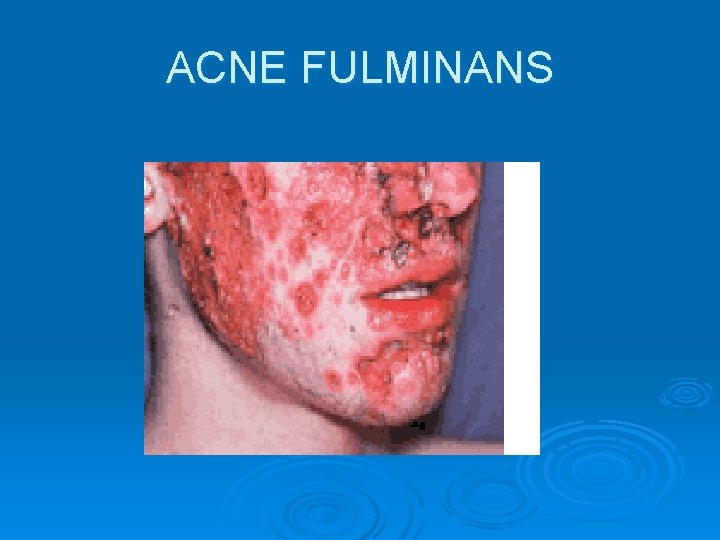 ACNE FULMINANS 