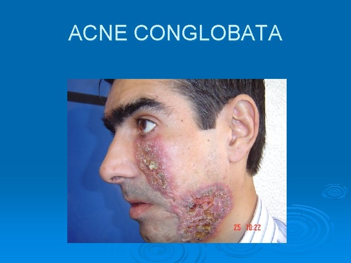 ACNE CONGLOBATA 