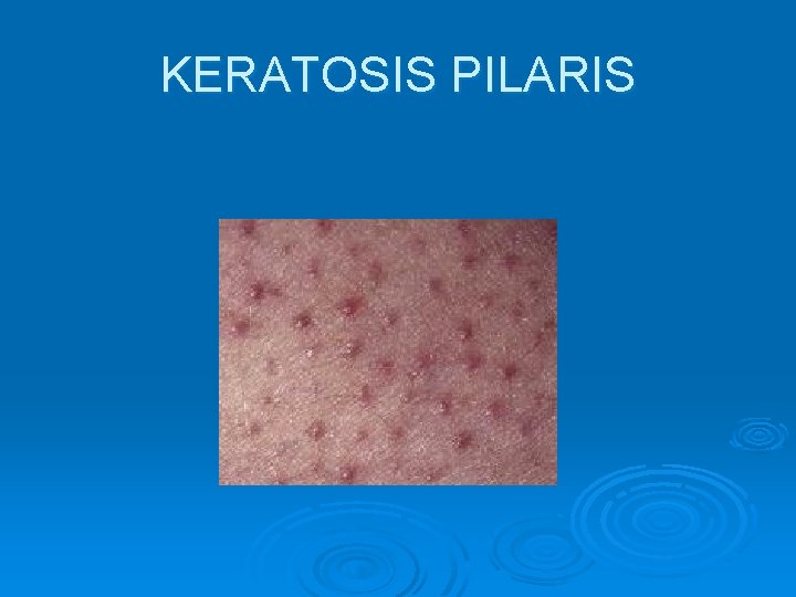 KERATOSIS PILARIS 
