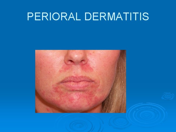 PERIORAL DERMATITIS 