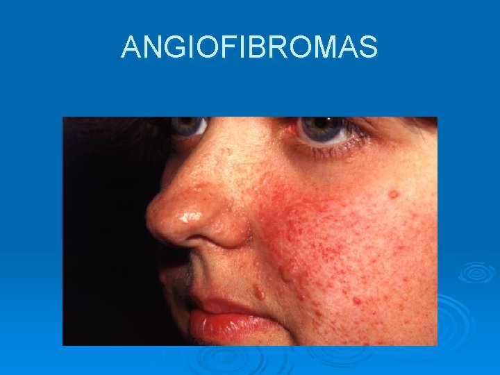 ANGIOFIBROMAS 