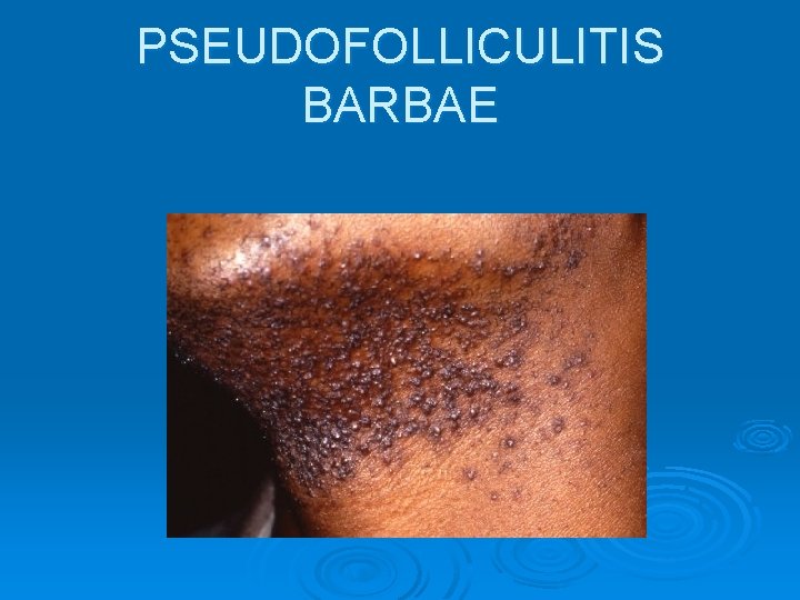 PSEUDOFOLLICULITIS BARBAE 