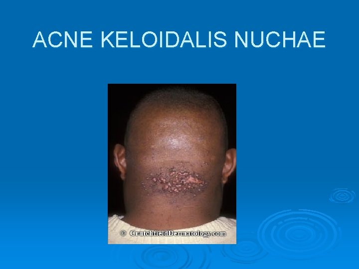 ACNE KELOIDALIS NUCHAE 