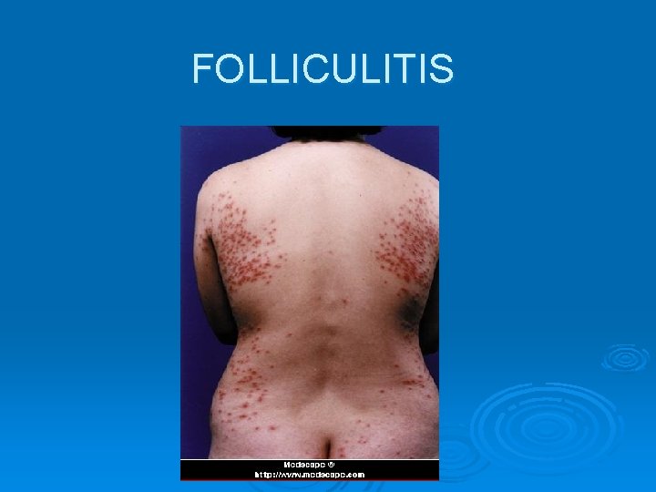 FOLLICULITIS 
