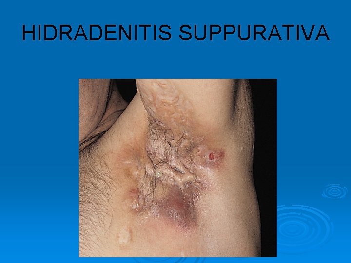 HIDRADENITIS SUPPURATIVA 