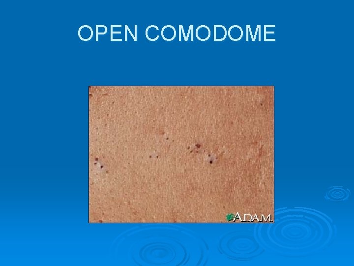 OPEN COMODOME 