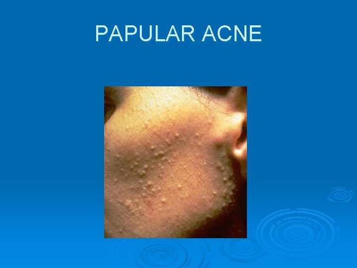 PAPULAR ACNE 