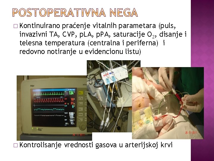 � Kontinuirano praćenje vitalnih parametara (puls, invazivni TA, CVP, p. LA, p. PA, saturacije