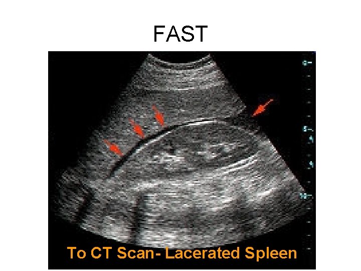 FAST To CT Scan- Lacerated Spleen 