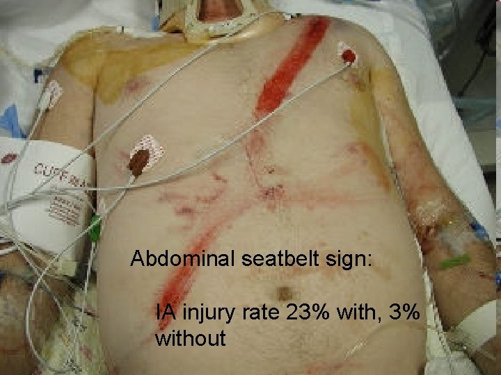 Abdominal seatbelt sign: IA injury rate 23% with, 3% without 