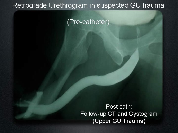Retrograde Urethrogram in suspected GU trauma (Pre-catheter) Post cath: Follow-up CT and Cystogram (Upper