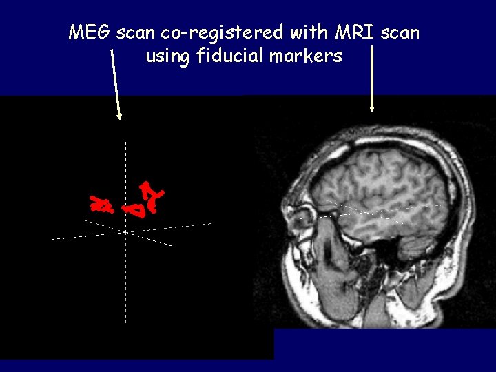 MEG scan co-registered with MRI scan using fiducial markers 