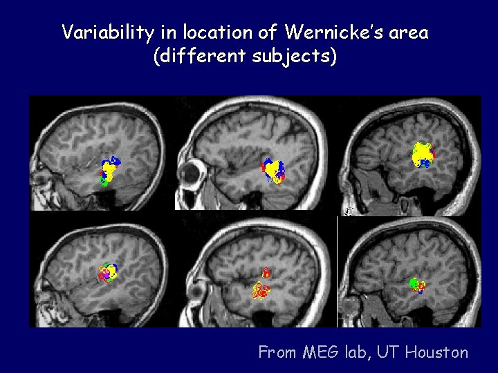 Variability in location of Wernicke’s area (different subjects) From MEG lab, UT Houston 