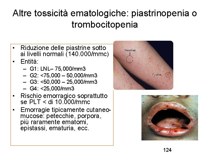 Altre tossicità ematologiche: piastrinopenia o trombocitopenia • Riduzione delle piastrine sotto ai livelli normali