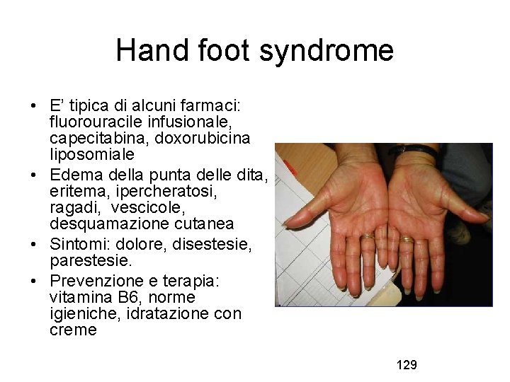Hand foot syndrome • E’ tipica di alcuni farmaci: fluorouracile infusionale, capecitabina, doxorubicina liposomiale