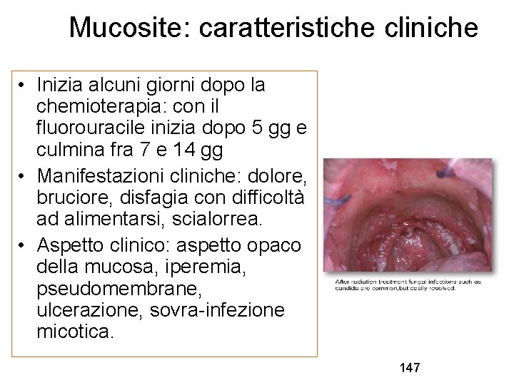 Mucosite: caratteristiche cliniche • Inizia alcuni giorni dopo la chemioterapia: con il fluorouracile inizia