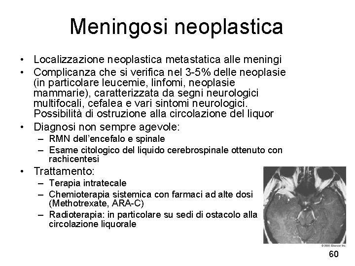 Meningosi neoplastica • Localizzazione neoplastica metastatica alle meningi • Complicanza che si verifica nel