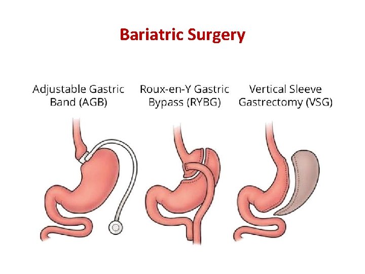 Bariatric Surgery 