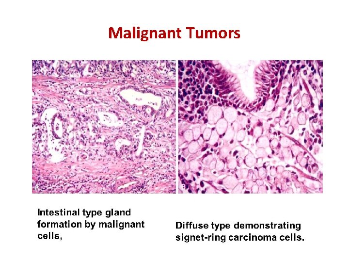Malignant Tumors 
