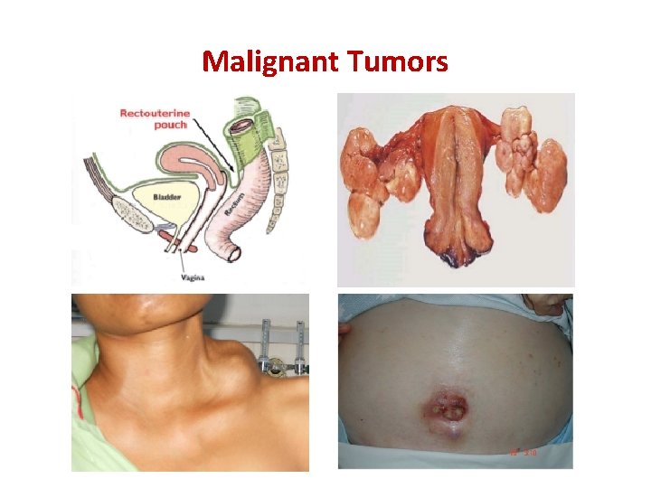Malignant Tumors 