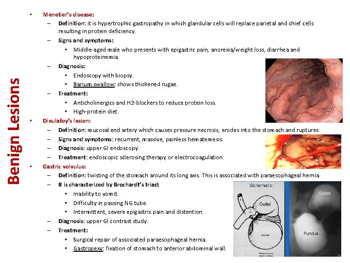 Benign Lesions • • • Menetier’s disease: – Definition: it is hypertrophic gastropathy in