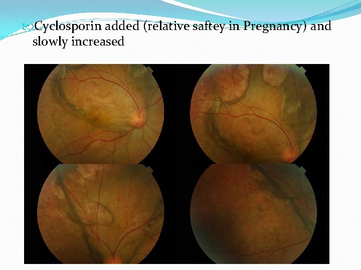  Cyclosporin added (relative saftey in Pregnancy) and slowly increased 