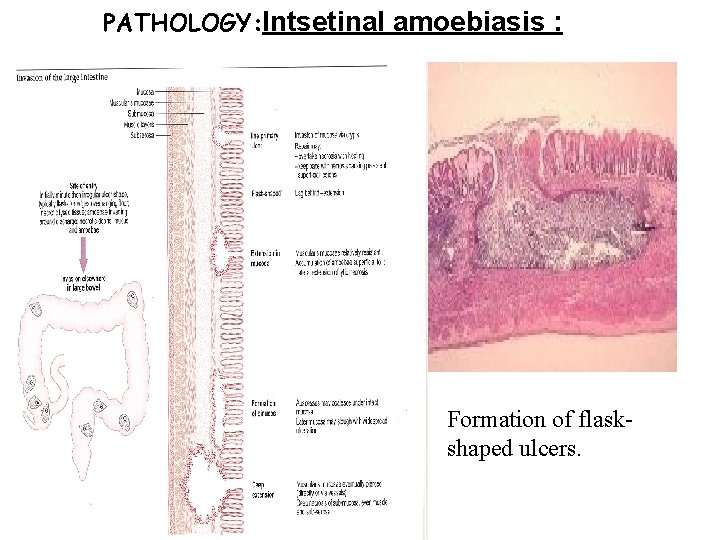 PATHOLOGY: Intsetinal amoebiasis : Formation of flaskshaped ulcers. 