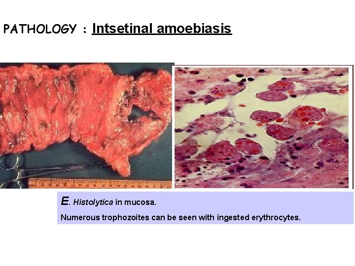 PATHOLOGY : Intsetinal amoebiasis E. Histolytica in mucosa. Numerous trophozoites can be seen with