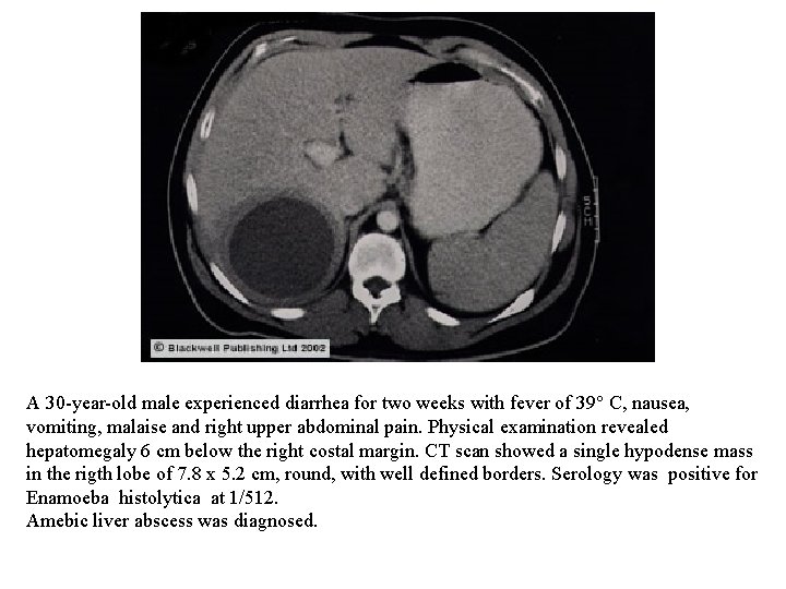 A 30 -year-old male experienced diarrhea for two weeks with fever of 39° C,