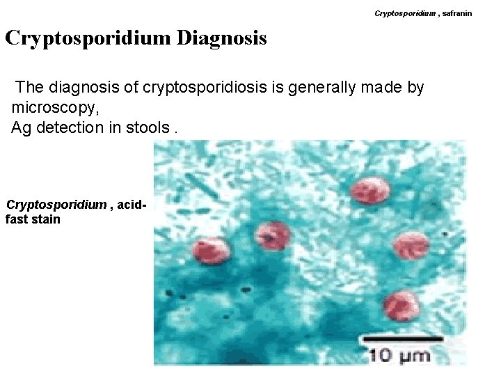 Cryptosporidium , safranin Cryptosporidium Diagnosis The diagnosis of cryptosporidiosis is generally made by .