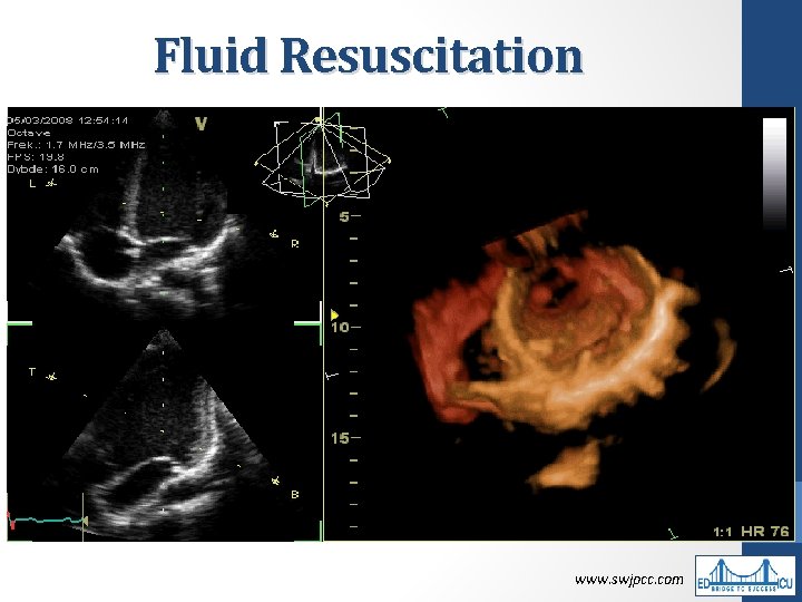 Fluid Resuscitation • Rapid 30 m. L/kg crystalloids, followed by response assessment • >4