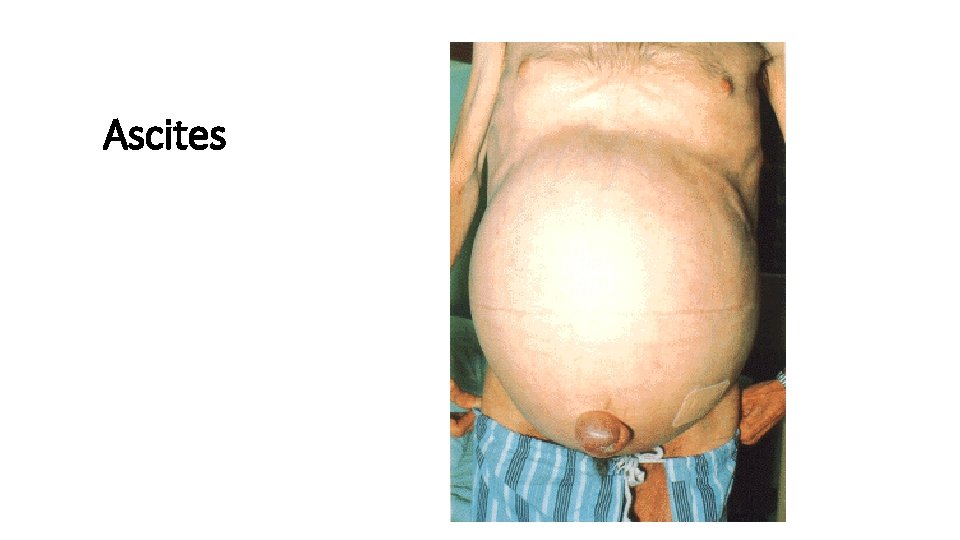 Ascites 