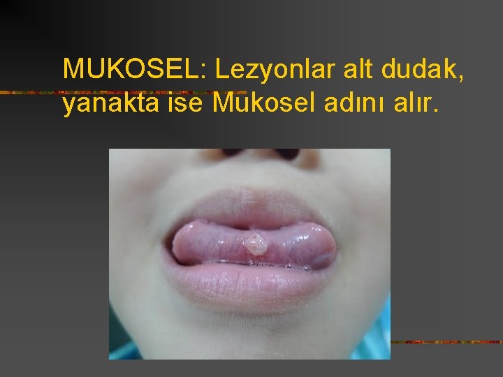 MUKOSEL: Lezyonlar alt dudak, yanakta ise Mukosel adını alır. 