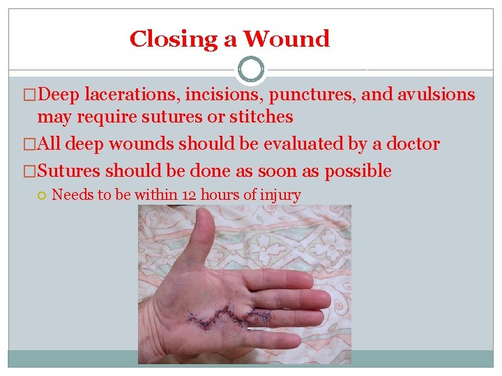 Closing a Wound �Deep lacerations, incisions, punctures, and avulsions may require sutures or stitches