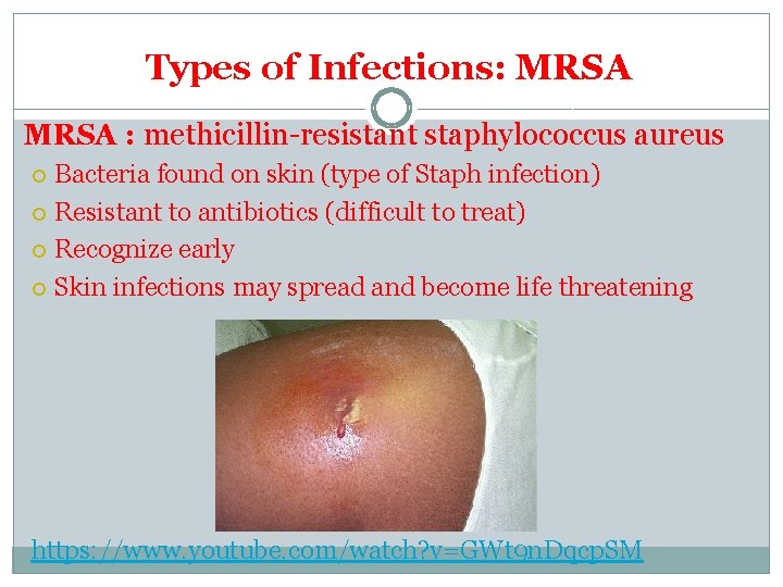 Types of Infections: MRSA : methicillin-resistant staphylococcus aureus Bacteria found on skin (type of